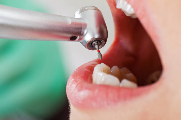 Best Emergency Root Canal Treatment in Louisville, CO